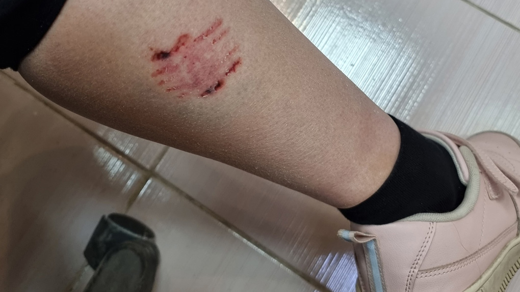Собака покусала Собака покусала