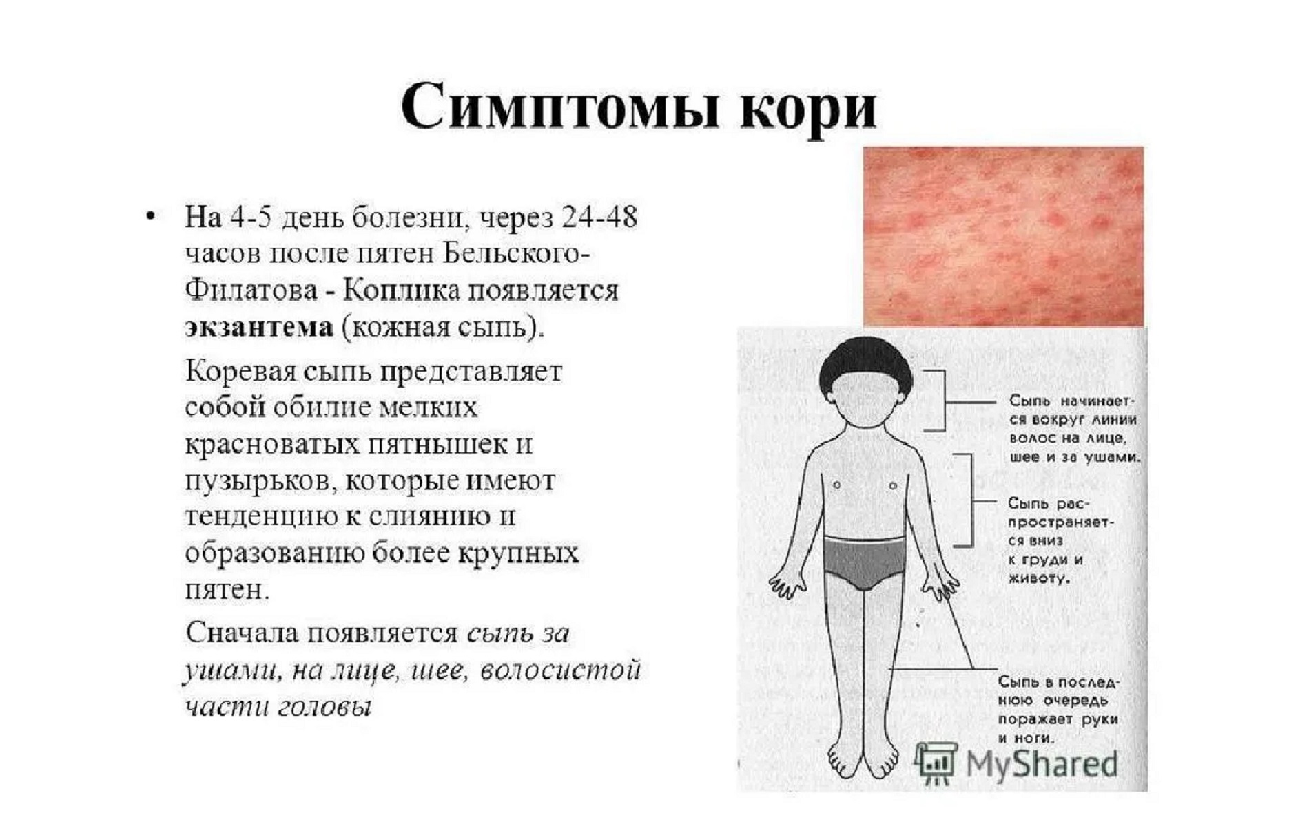 Сыпь отличия. Первые элементы сыпи при кори. Краснуха корь скарлатина сыпь. Первые элементы сыпи при кори у детей.