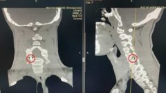 В Череповце нейрохирурги удалили из позвоночника участника СВО осколок снаряда