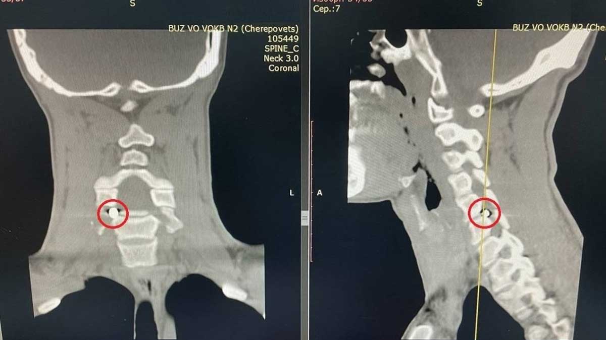 В Череповце нейрохирурги удалили из позвоночника участника СВО осколок снаряда