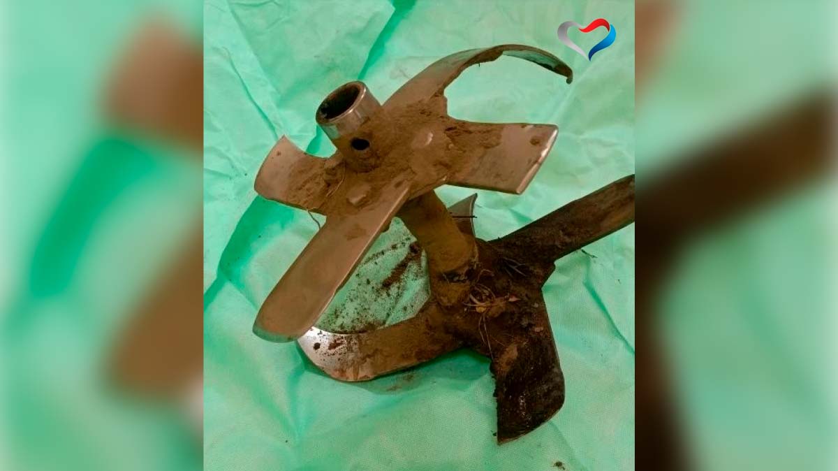 В Череповце врачи спасли ногу 74-летнему дачнику после травмы культиватором